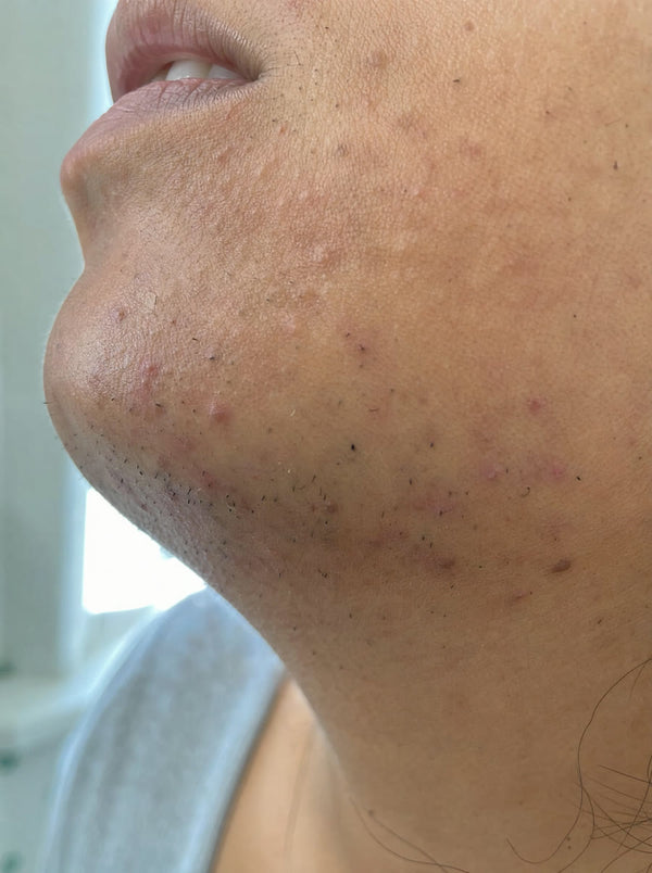 Bumps and dark marks